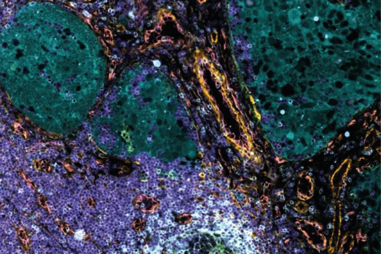 neuroblastoma_annelies